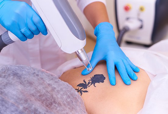 Roanoke Welcomes Advanced Technology for Tattoo Removal - The Roanoke Star  News