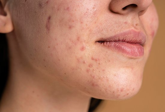 Clear Skin, Clear Confidence: Say Goodbye to Acne with Effective Treatments and Tips from LookLush